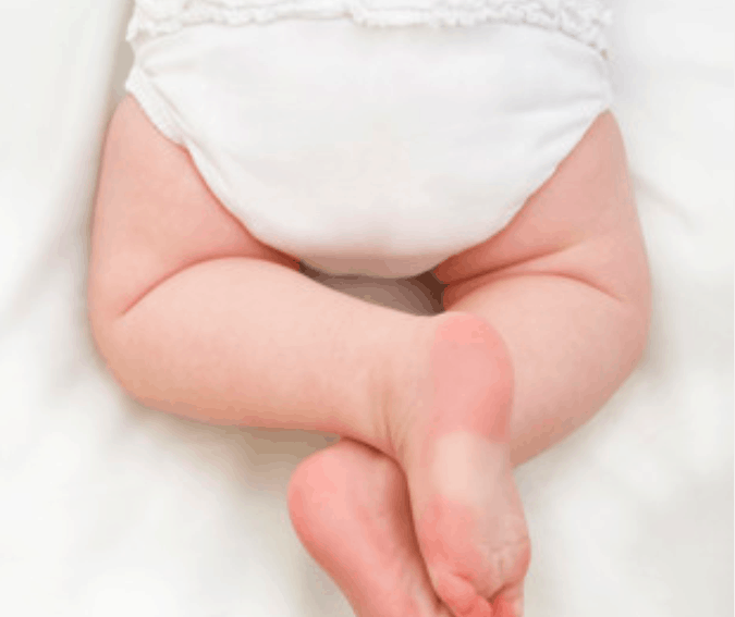 Tips Menjaga Kesehatan Kulit Bayi dari Ruam Popok dan Iritasi
